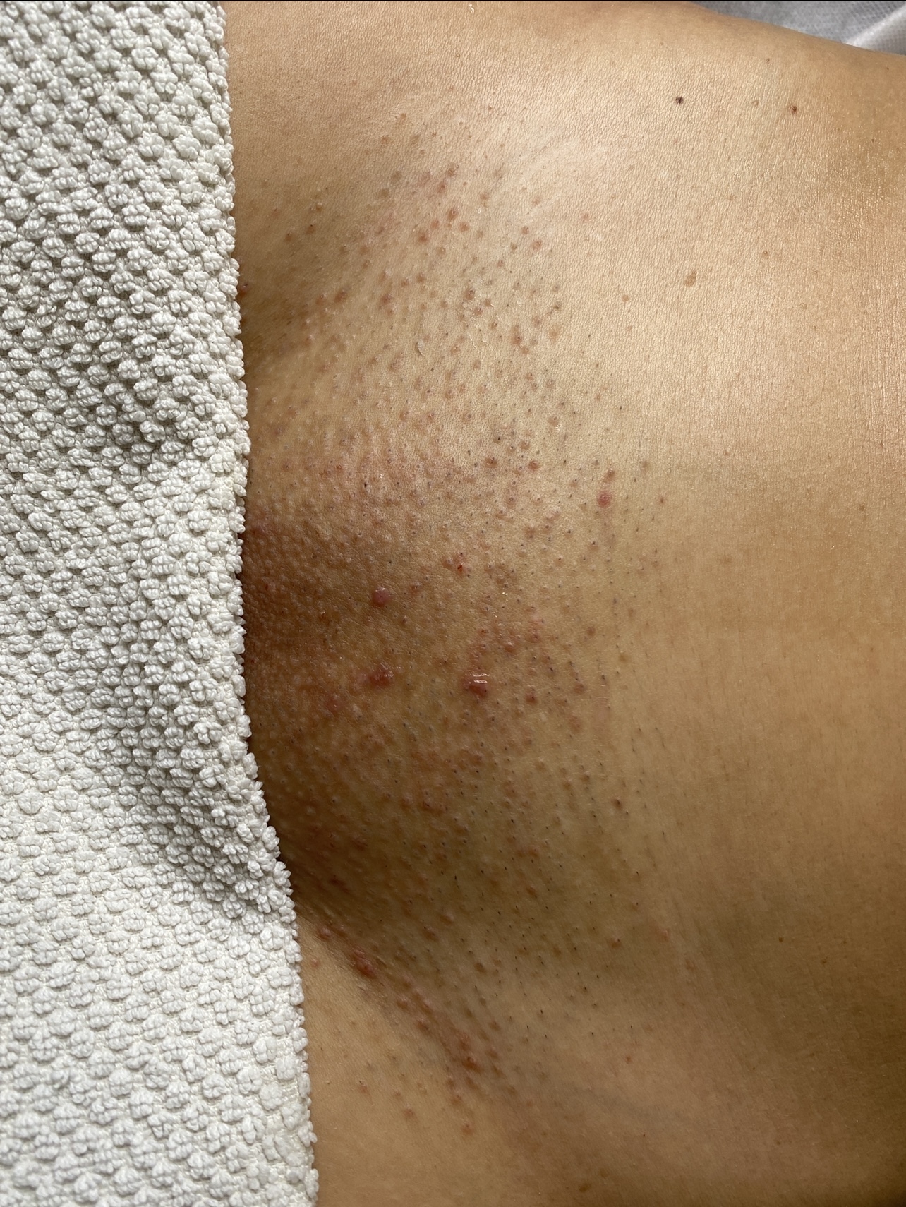 Kunde før permanent hårfjerning